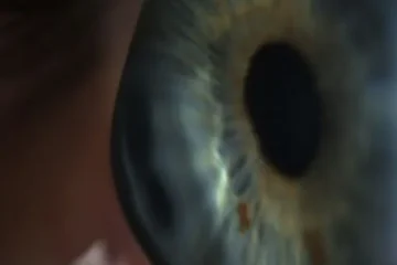 stożek rogówki soczewki