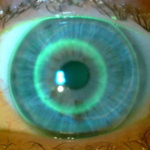 soczewka ortokorekcyjna na oku