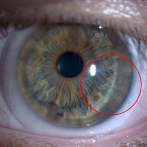 гибридная контактная линза на глазу