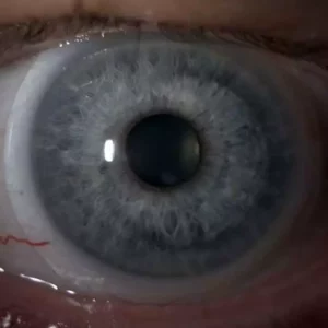 miniscleral contact len on the eye