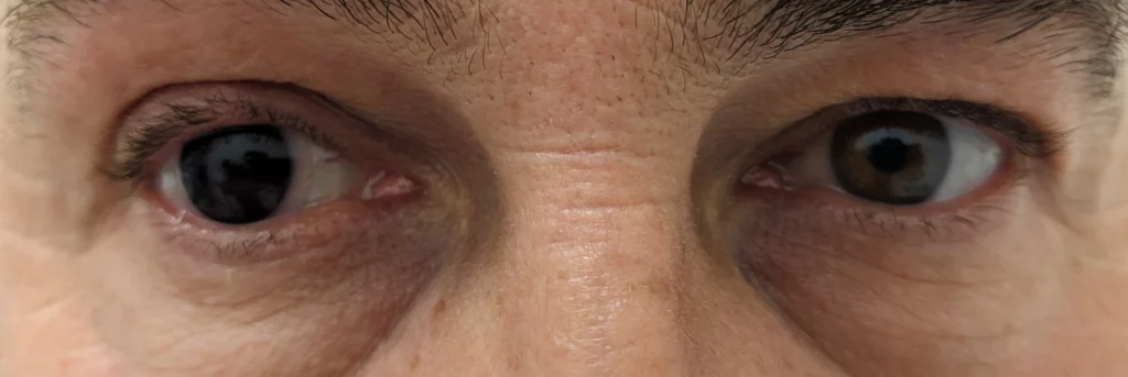 soczewka dla daltonistów na oku prawym