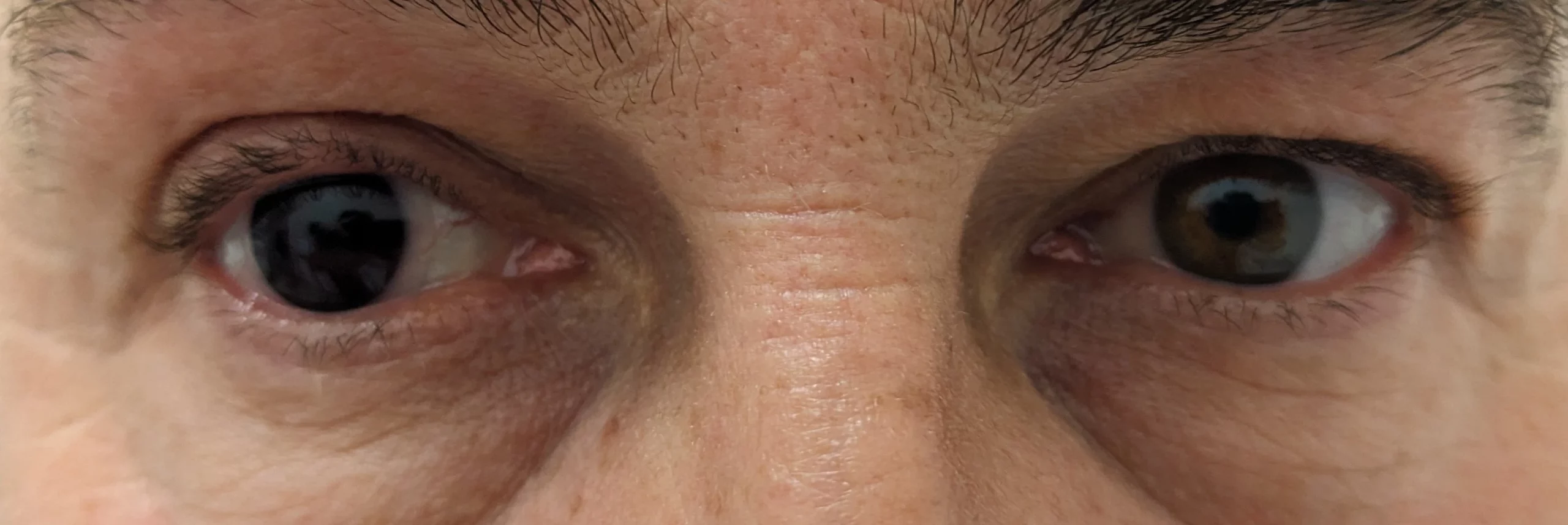 soczewka dla daltonistów na oku prawym